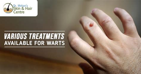 Warts Treatments Available