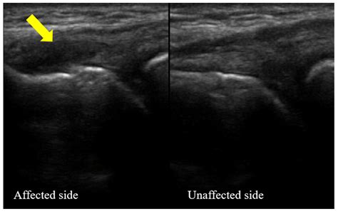Jpm Free Full Text Ultrasound Guided Injection Of Autologous