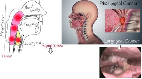 Throat Cancer Symptoms Causes And Treatment Laryngeal Cancer And Pharyngeal Cancer Youtube
