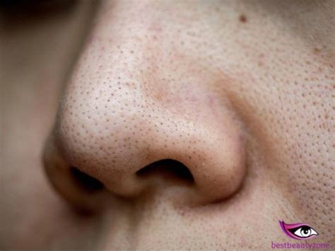 How To Get Of Clogged Pores On Nose Remedies Treatments And Products