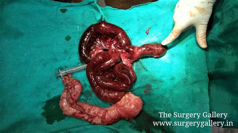 Gas and stool can't pass through. Intestinal obstruction and Gangrene caused by torsion of a ...