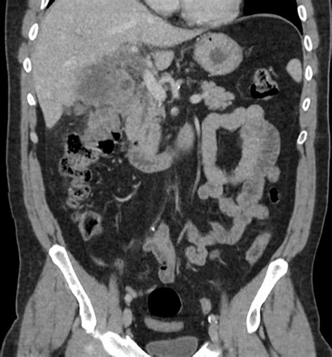 Perforated Gallbladder Empyema With Abscesses Formation Image