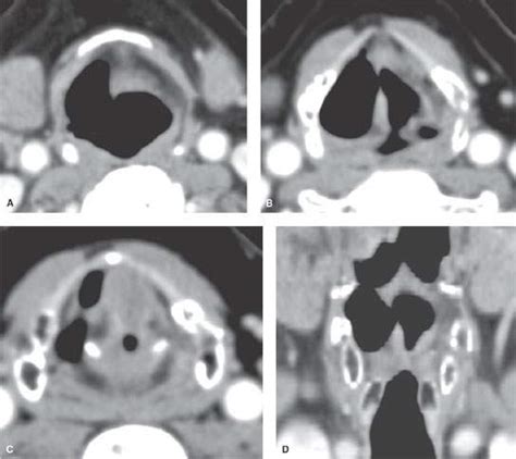 Laryngocele Radiology Key