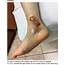 Woman 57 With Painful Swollen Ankle  Clinician Reviews