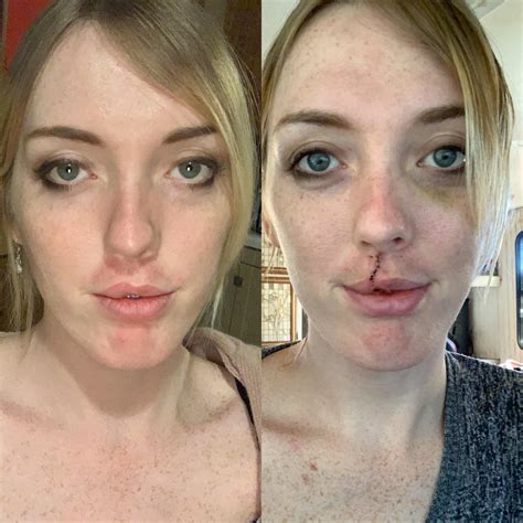 Before And After My Lip Surgery Scary Stitches But Good Results