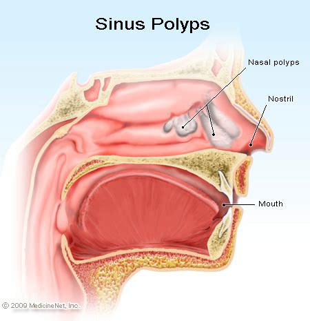 Nasal Polyps Causes Symptoms Pictures Treatment And Surgery