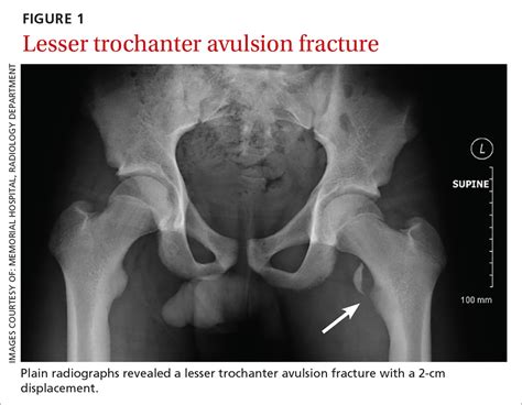 An avulsion fracture usually only needs the treatment of resting and icing the fracture followed by exercising and stretching the tendon. Hip pain • difficulty walking • tenderness along the ...
