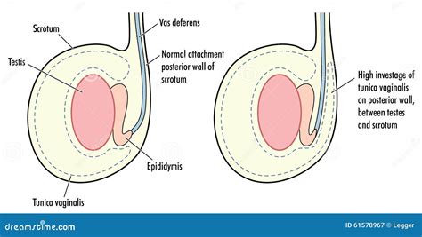 Normal Testicle And Testicle With High Tunica Vaginalis Illustration 61578967 Megapixl
