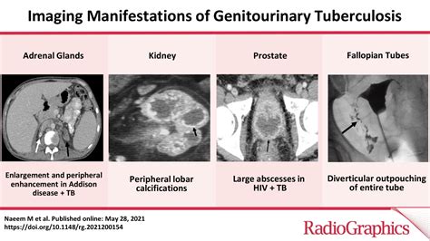 Imaging Manifestations Of Genitourinary Tuberculosis Radiographics