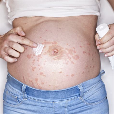 Itchy Skin During Early Pregnancy Hiccups Pregnancy