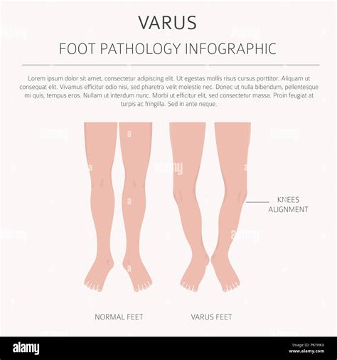 Deformación del pie como enfermedad médica infográfico Valgus y varo defecto Ilustración