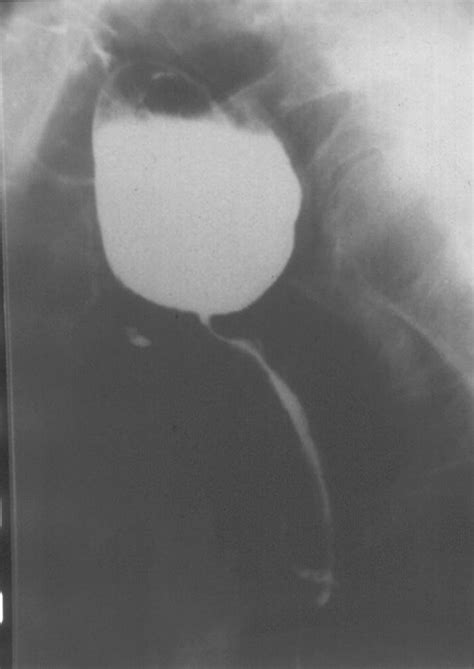 Long Peptic Stricture And A Zenkers Diverticulum Download Scientific