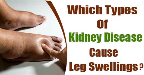 Kidney Failure Leg Swelling Leg Swelling Kidney Disease