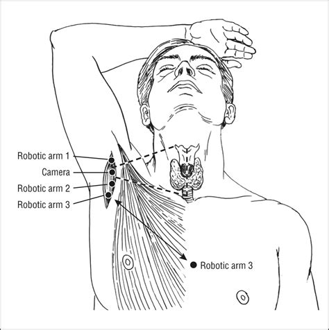 Transaxillary Gasless Robotic Thyroidectomy A Single Surgeon S