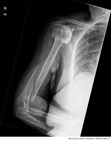Surgical Treatment Of Extra Articular Distal Third Diaphyseal Fractures