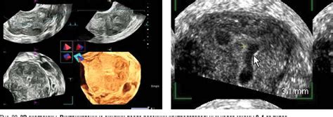 Figure 20 From Ultrasound Assessment Of The Uterine Wall After