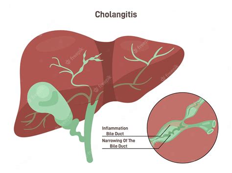 Premium Vector Cholangitis Or Ascending Cholangitis Infection And