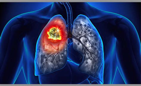 Lung Cancer Patients May Benefit From Delayed Chemotherapy After Surgery
