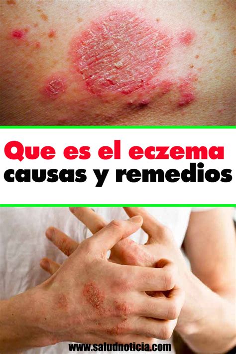 Que Es El Eczema Causas Y Remedios Ale