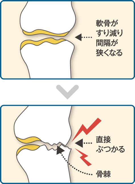 変形性関節症の症状とおすすめ福祉用具｜介護用品のレンタル ...