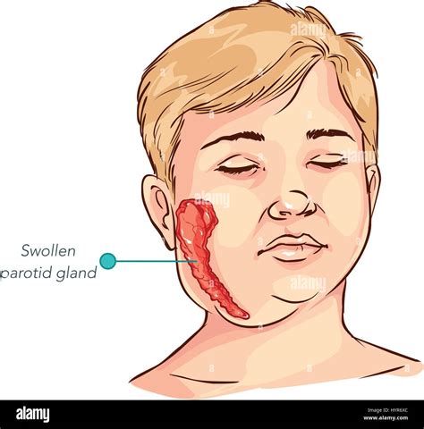 Children Salivary Gland Swelling Vector Illustration Stock Vector Image