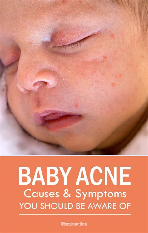 Baby Acne On Face Natural Treatment Wererabbits