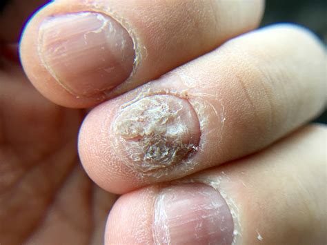 Sinais De Psoríase Nas Unhas E Como Diferenciá La De Micose