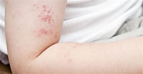 Shingles Symptoms Causes Risk Factors And Natural Treatments Well