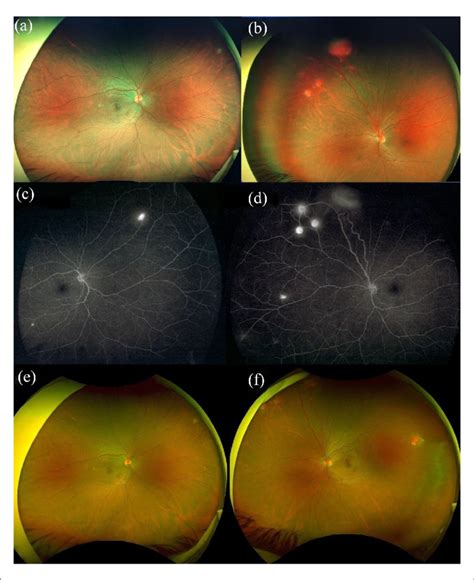 Fundus Photography By Ultra Wide Field Uwf Optos Imaging Shows