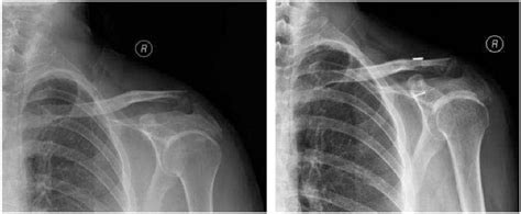 Figure 1 From Treatment Of Unstable Distal Clavicle Fractures Neer