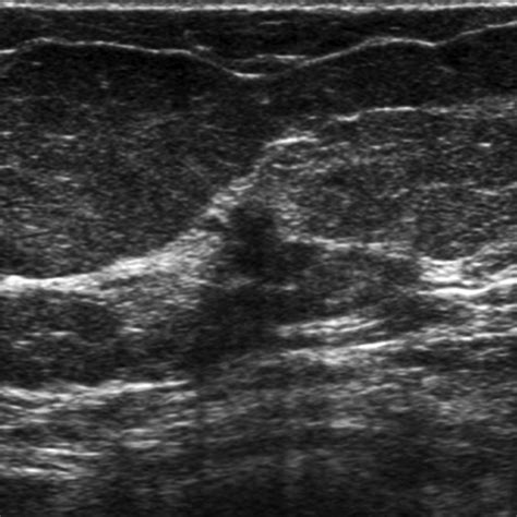 Correlation Between Sonographic Findings And Clinicopathologic And