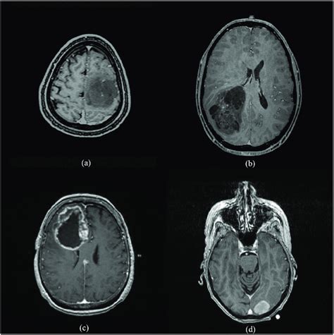 Two Cases Of Low Grade Gliomas A B And Two Cases Of Glioblastomas