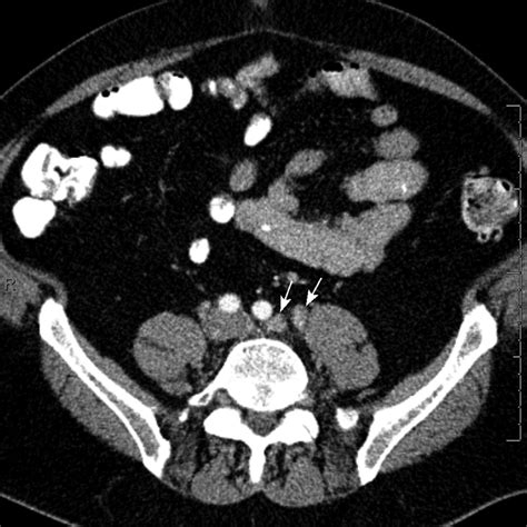 Contrast Enhanced Axial Ct Scan Image Through The Upper Pelvis
