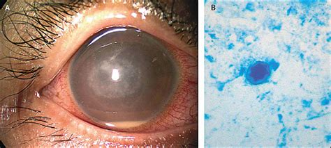 Swimming With Soft Contact Lenses Danger Of Acanthamoeba Keratitis