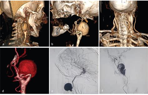 Extracranial Internal Carotid Artery Aneurysm Treated With High Flow Bypass Surgery With Radial