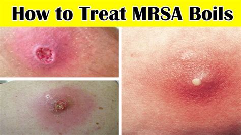 Top 6 Home Remedies For Mrsa Boils How To Treat Mrsa Boils At Home