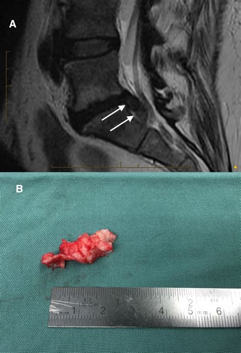 Lumbar Microdiscectomy Surgery Minimally Invasive Keyhole Discectomy