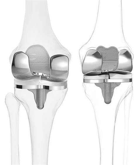 Three Compartment Knee Prosthesis Itotal® Cr Conformis Sliding
