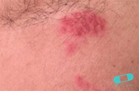 Treatment is usually given for 7 days in the absence. Herpes Zoster (Shingles) - Online Dermatology