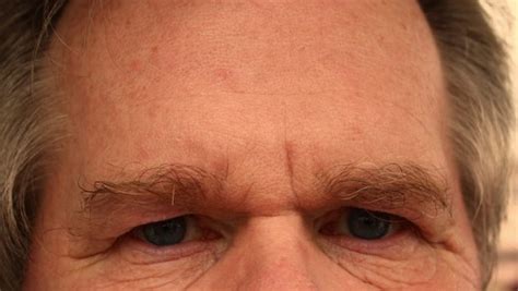 Easy Treatment And Tips For Flaky And Dry Skin On Forehead And Face