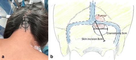 Keyhole Craniotomy And Skin Incision A Photograph Of Actual Patient