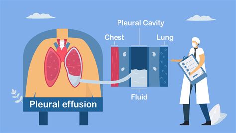 Doen A Pulmonar Sobre Derrame Pleural Vetor No Vecteezy