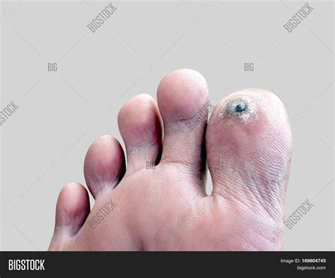 Corn On Foot Finger Image And Photo Free Trial Bigstock