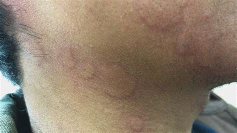 Skin Rash On One Side Of Face Allergy Trigger