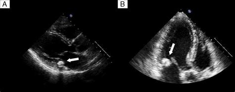 Caseous Calcification Of The Mitral Annulus A Rare Echocardiographic