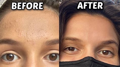 How To Get Rid Of Forehead Bumpstexture And Adult Acne Youtube