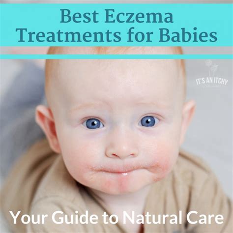 Best Eczema Treatments For Babies Your Guide To Natural Care