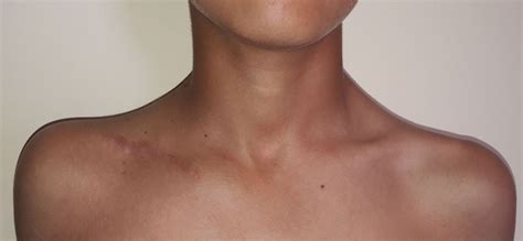 Congenital Pseudarthrosis Of The Clavicle Treated By Masquelet