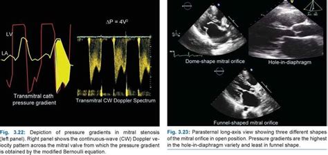 Mitral Stenosis A Practical Approach To Clinical Echocardiography St