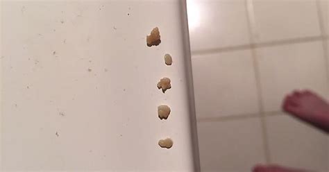 These Came Out Of My Right Tonsil Imgur